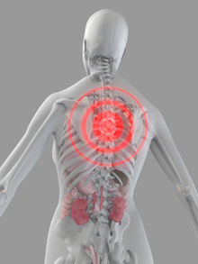 Motorcycle Accidents and Spinal Injuries